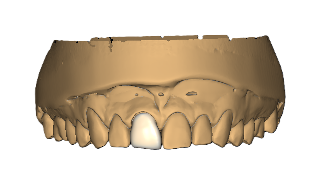 Single Crown After